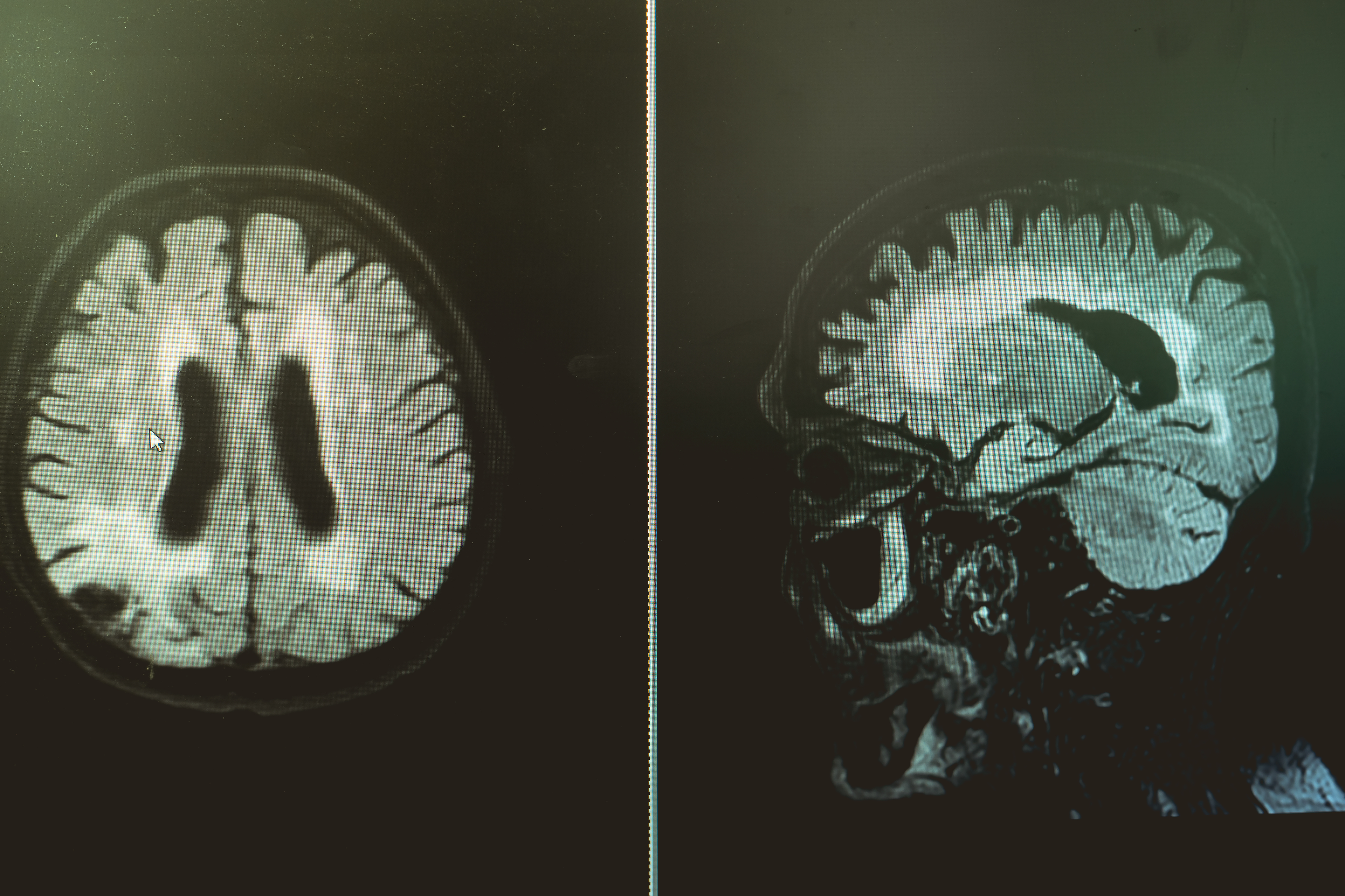 MRI Study Reveals Increased Brain Changes in Postmenopausal Women