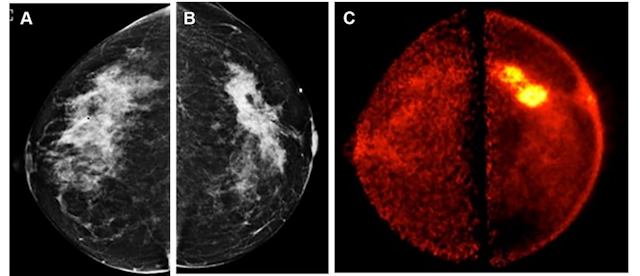 Can Positron Emission Mammography Have an Impact in Diagnosing Invasive Breast Cancer?
