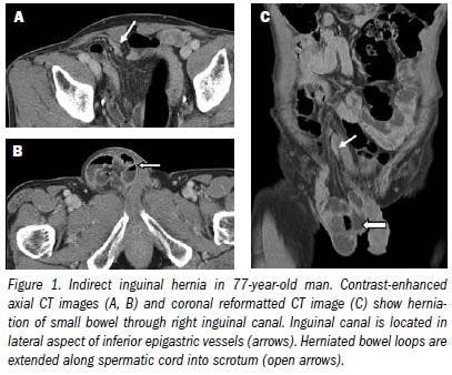 Multidetector CT reveals diverse variety of abdominal hernias