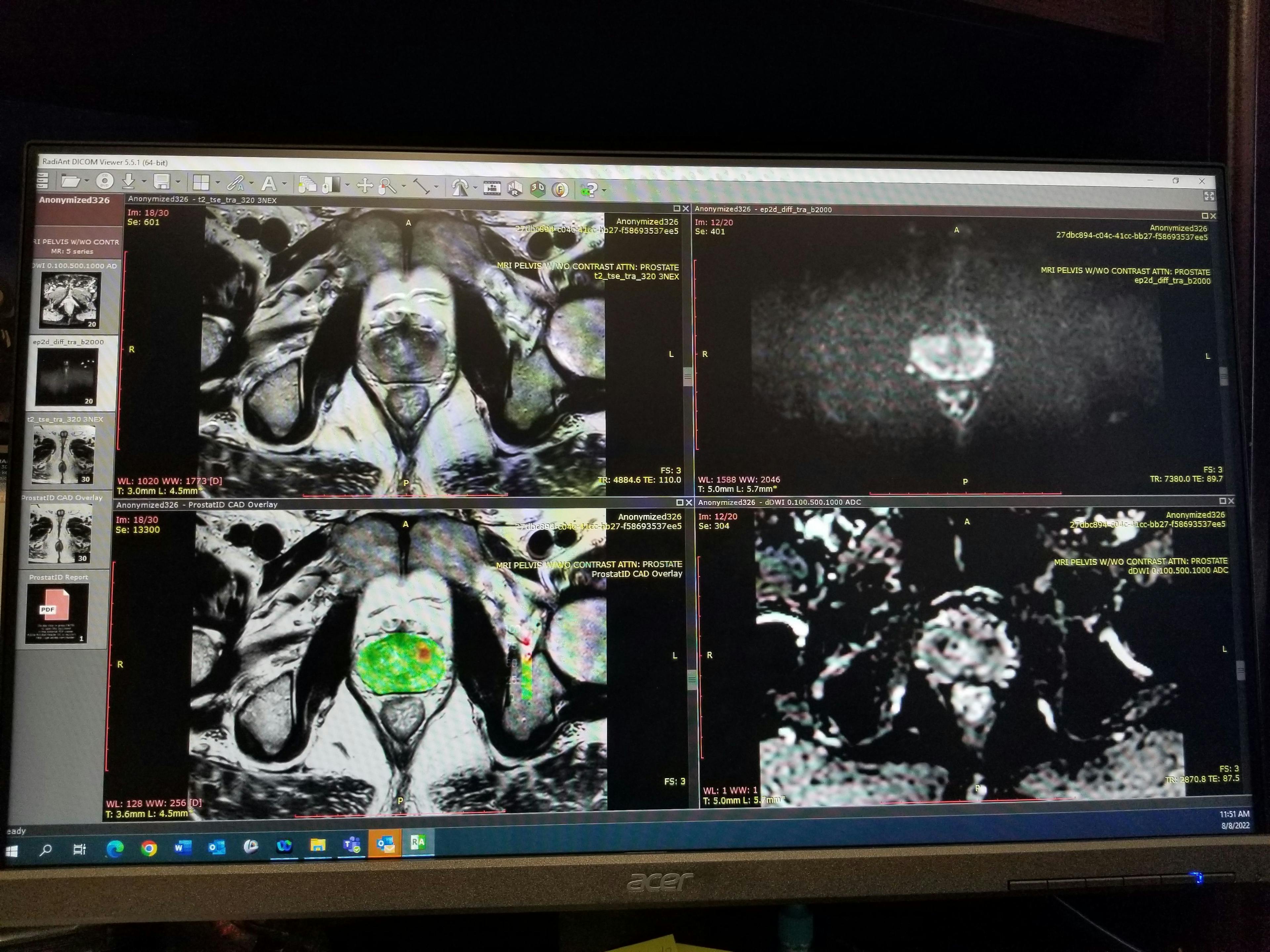 FDA Clears New AI Software for MRI Detection of Prostate Cancer
