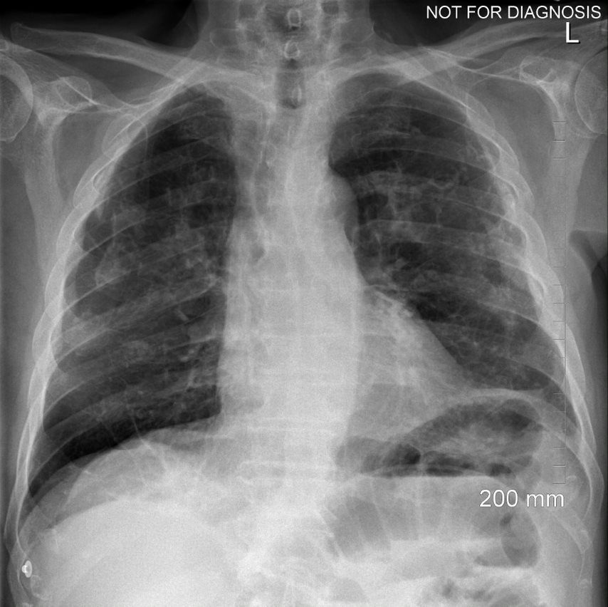 Image IQ: 56-year-old construction worker presents with dry cough
