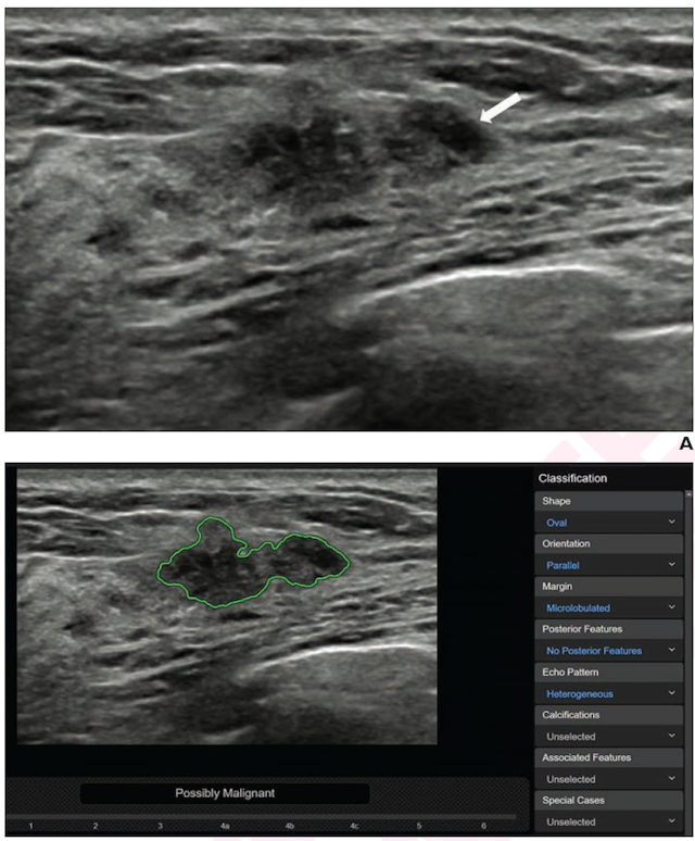 AI and Breast Ultrasound: Where Things Stand
