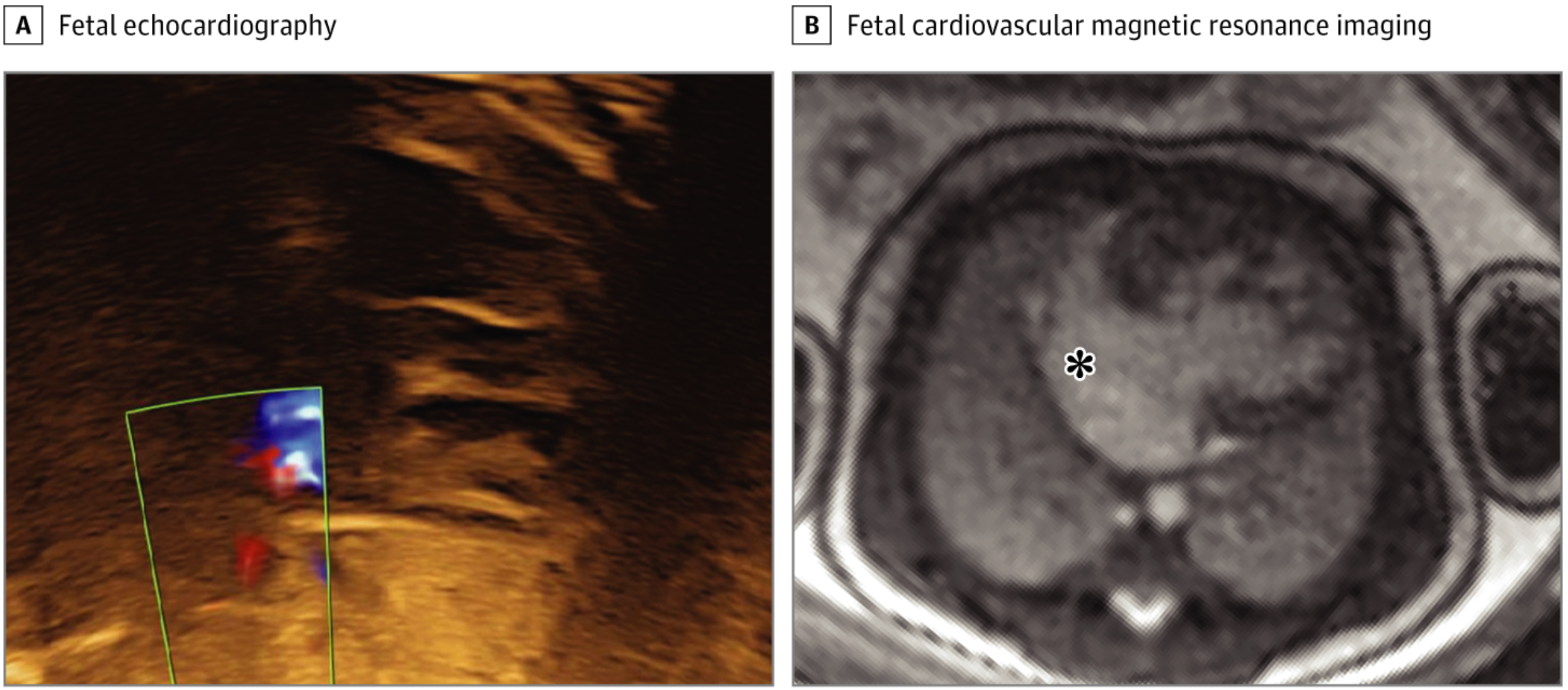Fetal echocardiography could not visualize the atrial cavity or Doppler flow across the atrial septum due to poor acoustic windows (A). Fetal cardiovascular magnetic resonance showed a large interatrial communication, indicated by the asterisk, and no nutmeg pattern (B). Therefore, the risk of restrictive atrial septum was considered low (albeit a membrane could not be ruled out), and the fetus was planned for a vaginal delivery without cardiac catheterization laboratory on standby.

Credit: JAMA Network Open