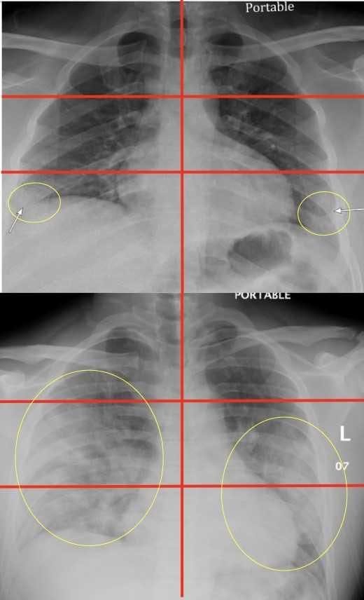 Chest X-rays Can Predict COVID-19 Severity in Young and Middle-Age ER Patients