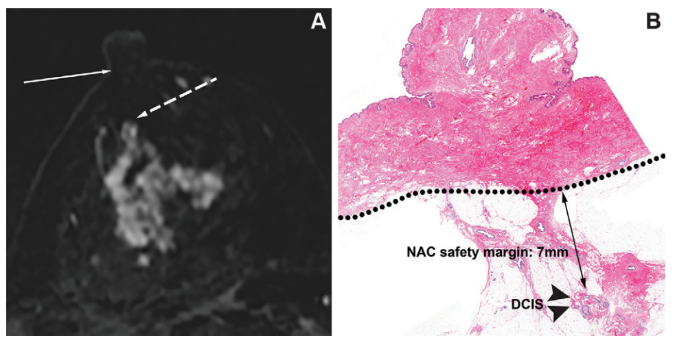 Images in a 43-year-old woman in the nonmass enhancement (NME) nonextension group without pathologic nipple invasion. (A) Contrast-enhanced fat-suppressed T1-weighted axial MRI scan obtained in first postcontrast phase shows that NME continues to the tumor and extends toward the nipple but does not reach the nipple base (solid arrow). The radiologic distance between the nipple base and the closest NME (dashed arrow) is 1.4 cm. (B) Photomicrograph (hematoxylin-eosin stain; original magnification, 35) shows the pathologic distance between the nipple baseline (dotted line) and the nearest tumor (arrowheads) is 0.7 cm. DCIS = ductal carcinoma in situ, NAC = nipple-areolar complex.

Credit: RSNA