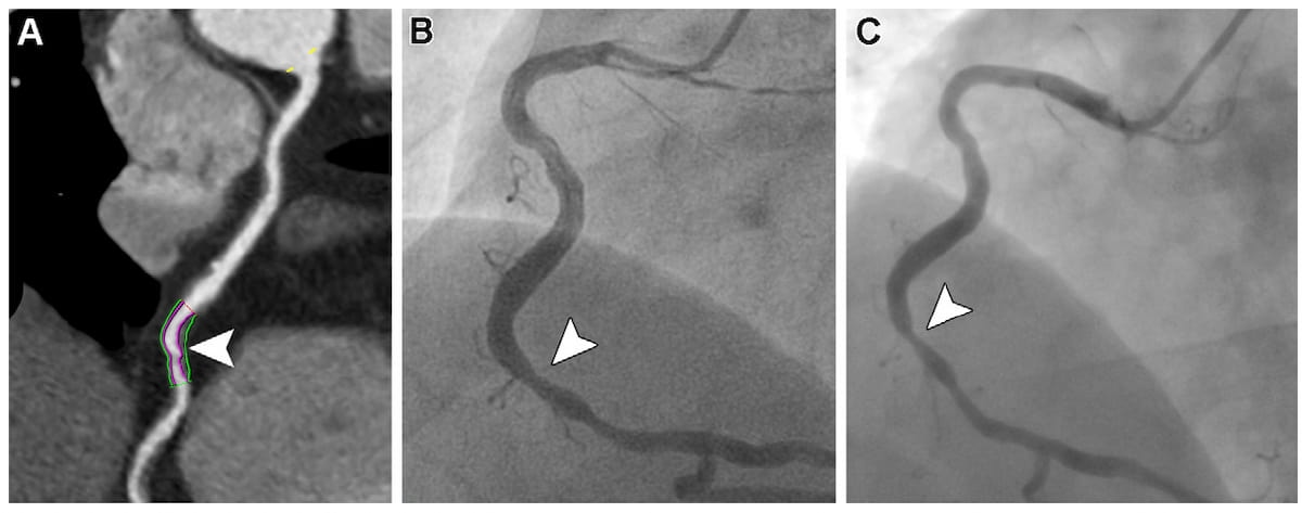 Coronary CT Angiography Study Shows Link Between Major Cardiovascular Events and High Lipid Core Burden 