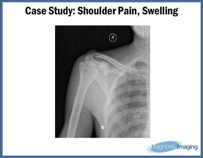 Shoulder Pain, Swelling