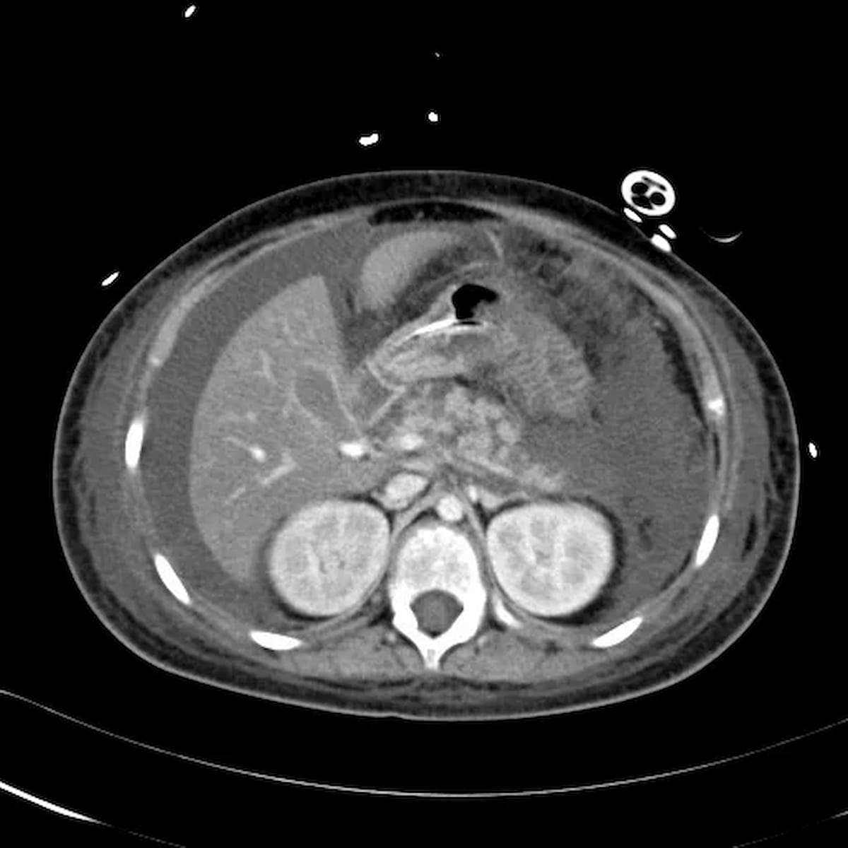 Image IQ Quiz: Patient with Abdominal Pain, New Medications, and Elevated Lipase