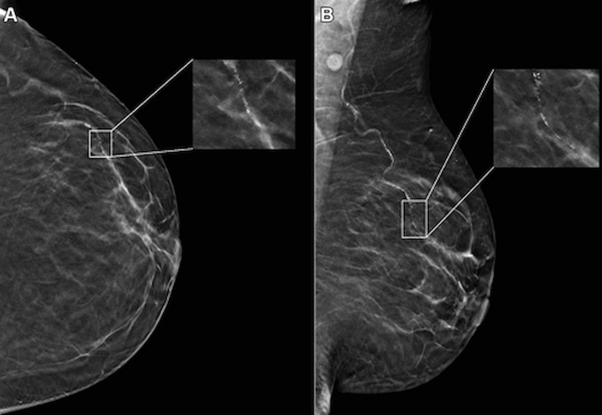 Study of Mammography AI Software Notes 50 Percent Higher Likelihood of False-Positive Results for Black Women